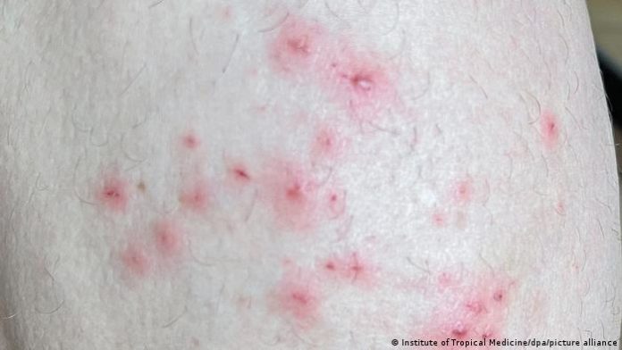 Monkeypox: How to protect yourself against the virus – DW (English ...